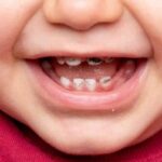 Tooth Decay in Children and Adults: What Actually Causes It (and How to Prevent It)