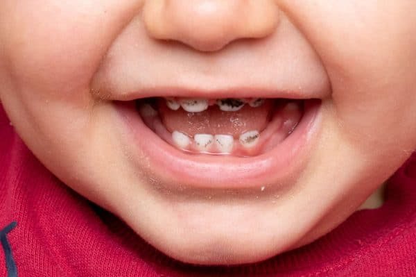 Tooth Decay in Children and Adults: What Actually Causes It (and How to Prevent It)